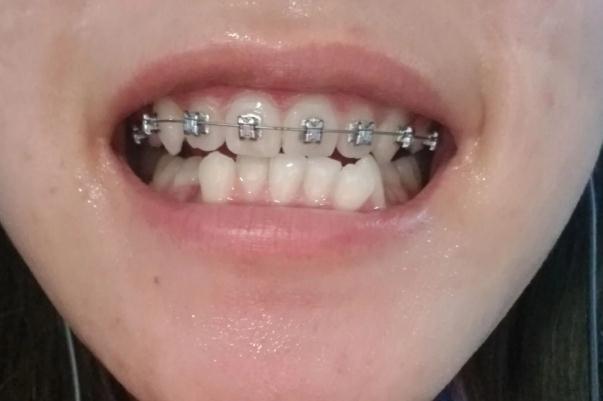 牙套多大年齡可以戴 3歲小孩可以戴牙套嗎 牙套多大年齡可以戴 3歲小孩可以戴牙套嗎