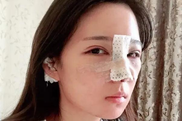 耳軟骨隆鼻耳軟骨還會長起來嗎 耳軟骨隆鼻會頂破鼻尖嗎 耳軟骨隆鼻耳軟骨還會長起來嗎 耳軟骨隆鼻會頂破鼻尖嗎