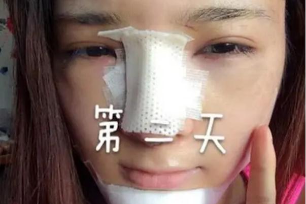 耳軟骨隆鼻是取一側(cè)還是兩側(cè) 耳軟骨隆鼻是用自己的耳軟骨嗎 耳軟骨隆鼻是取一側(cè)還是兩側(cè) 耳軟骨隆鼻是用自己的耳軟骨嗎