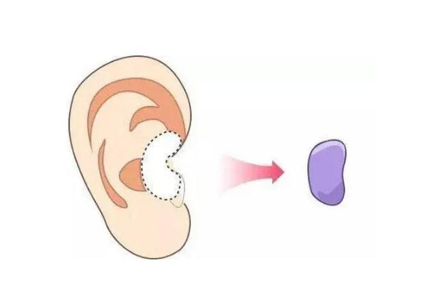 耳軟骨隆鼻是取耳朵哪里的骨頭 耳軟骨隆鼻是全麻還是局麻 耳軟骨隆鼻是取耳朵哪里的骨頭 耳軟骨隆鼻是全麻還是局麻