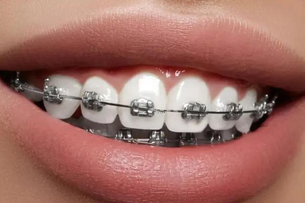 牙套多大年齡可以戴 3歲小孩可以戴牙套嗎 牙套多大年齡可以戴 3歲小孩可以戴牙套嗎