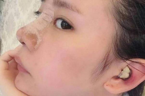 耳軟骨隆鼻是取耳朵哪里的骨頭 耳軟骨隆鼻是全麻還是局麻 耳軟骨隆鼻是取耳朵哪里的骨頭 耳軟骨隆鼻是全麻還是局麻