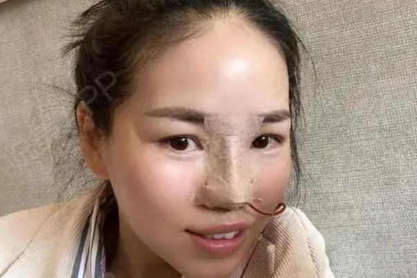 耳軟骨隆鼻會攣縮嗎 耳軟骨隆鼻會變形嗎 耳軟骨隆鼻會攣縮嗎 耳軟骨隆鼻會變形嗎