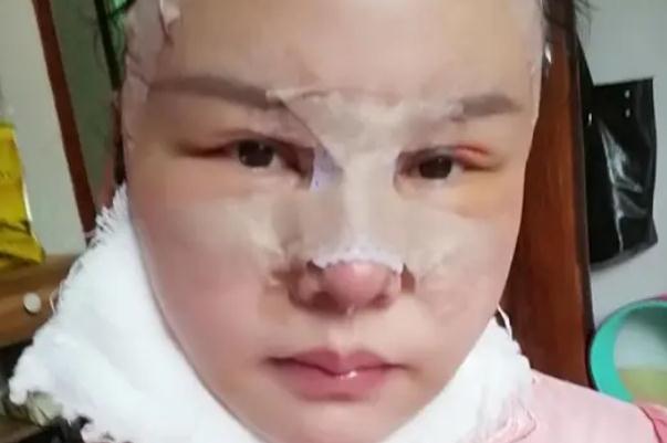 耳軟骨隆鼻有異物感 耳軟骨隆鼻有鼻炎可以做嗎 耳軟骨隆鼻有異物感 耳軟骨隆鼻有鼻炎可以做嗎