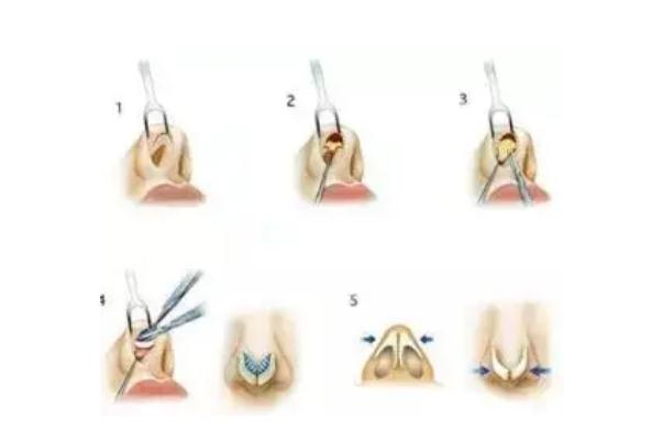 膨體隆鼻可以一輩子不取出來嗎 膨體隆鼻可以維持多少年 膨體隆鼻可以一輩子不取出來嗎 膨體隆鼻可以維持多少年