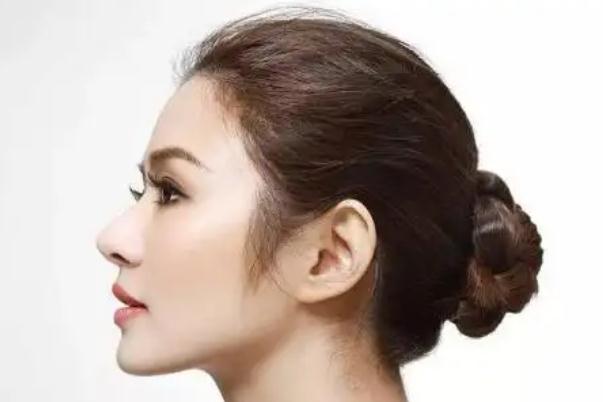 膨體隆鼻會移位嗎 膨體隆鼻會透光嗎 膨體隆鼻會移位嗎 膨體隆鼻會透光嗎