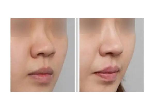 膨體隆鼻會移位嗎 膨體隆鼻會透光嗎 膨體隆鼻會移位嗎 膨體隆鼻會透光嗎