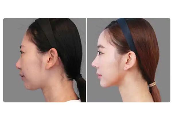 墊下巴什么方式最安全永久 墊下巴手術(shù)風(fēng)險(xiǎn)大嗎 墊下巴什么方式最安全永久 墊下巴手術(shù)風(fēng)險(xiǎn)大嗎