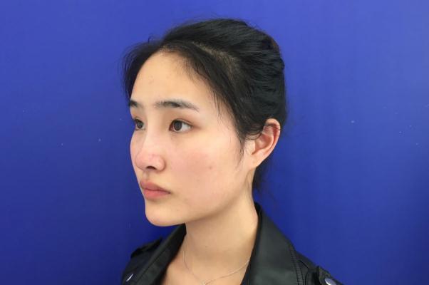 墊下巴是幾級手術 墊下巴是永久的嗎 墊下巴是幾級手術 墊下巴是永久的嗎