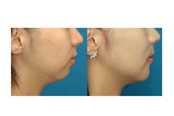 墊下巴什么方式最安全永久 墊下巴手術(shù)風(fēng)險(xiǎn)大嗎 墊下巴什么方式最安全永久 墊下巴手術(shù)風(fēng)險(xiǎn)大嗎