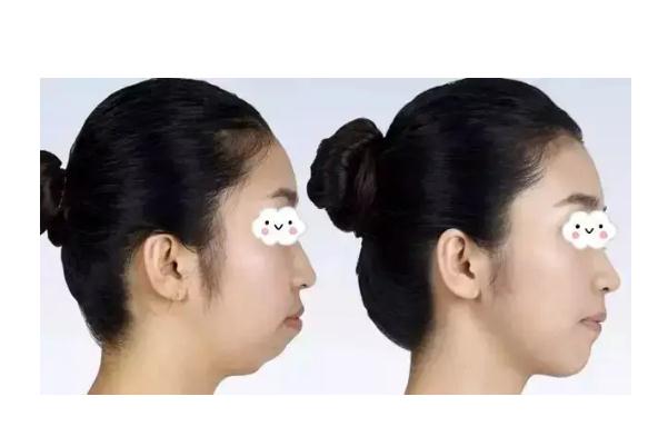 墊下巴要住院嗎 墊下巴要換身份證嗎 墊下巴要住院嗎 墊下巴要換身份證嗎