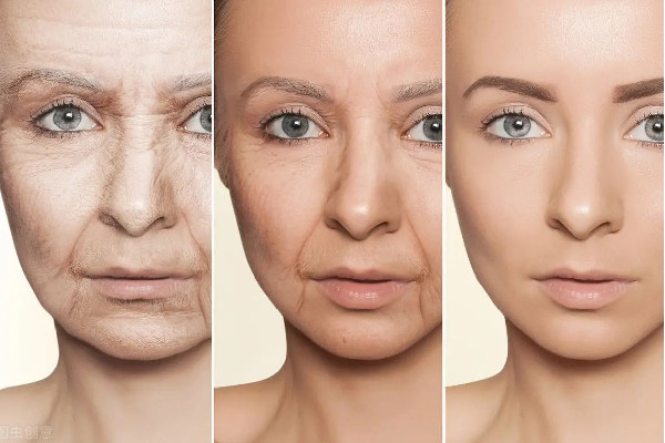 除皺針間隔多久打一次 除皺針打多了會(huì)怎么樣 除皺針間隔多久打一次 除皺針打多了會(huì)怎么樣