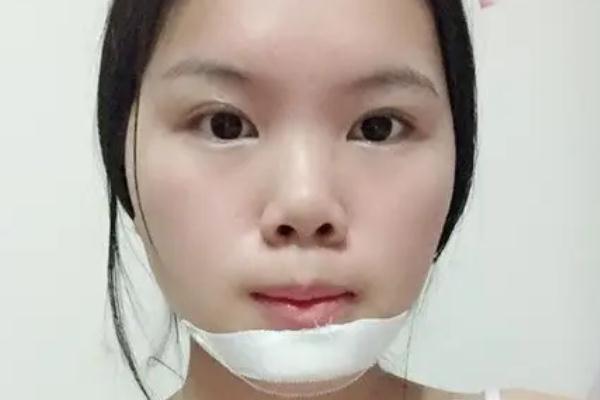 墊下巴要住院嗎 墊下巴要換身份證嗎 墊下巴要住院嗎 墊下巴要換身份證嗎