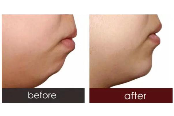 墊下巴為什么不能吃牛肉 墊下巴為什么會(huì)酸疼 墊下巴為什么不能吃牛肉 墊下巴為什么會(huì)酸疼