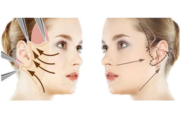 拉皮手術(shù)能維持幾年 拉皮手術(shù)多久恢復(fù)自然 拉皮手術(shù)能維持幾年 拉皮手術(shù)多久恢復(fù)自然