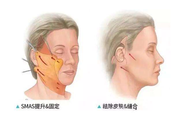 拉皮手術(shù)能維持幾年 拉皮手術(shù)多久恢復(fù)自然 拉皮手術(shù)能維持幾年 拉皮手術(shù)多久恢復(fù)自然