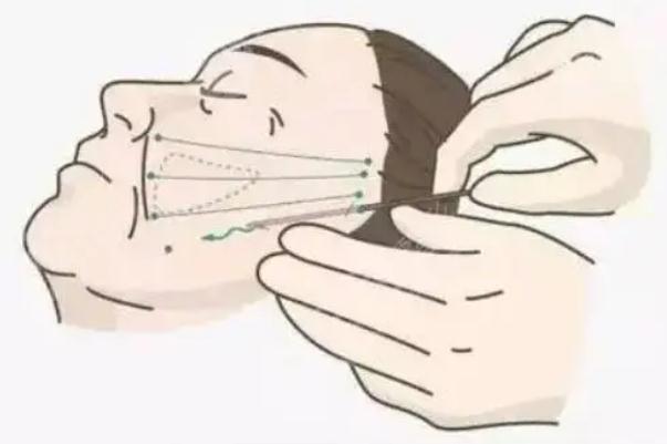 拉皮手術(shù)有后遺癥嗎 拉皮手術(shù)有風(fēng)險(xiǎn)嗎 拉皮手術(shù)有后遺癥嗎 拉皮手術(shù)有風(fēng)險(xiǎn)嗎