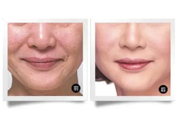 拉皮手術有生命危險嗎 拉皮手術會留疤痕嗎 拉皮手術有生命危險嗎 拉皮手術會留疤痕嗎