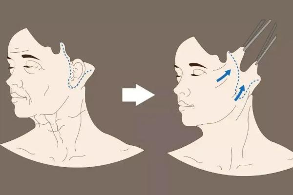 拉皮手術(shù)后頭套戴多久 拉皮手術(shù)恢復(fù)期多少天 拉皮手術(shù)后頭套戴多久 拉皮手術(shù)恢復(fù)期多少天