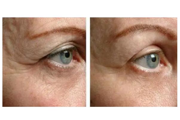 拉皮手術有生命危險嗎 拉皮手術會留疤痕嗎 拉皮手術有生命危險嗎 拉皮手術會留疤痕嗎