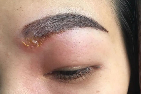 激光洗眉一般多少錢 激光洗眉去醫(yī)院還是美容院 激光洗眉一般多少錢 激光洗眉去醫(yī)院還是美容院