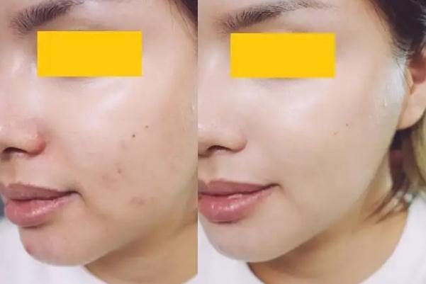 童顏針是什么成分 童顏針是干細(xì)胞嗎 童顏針是什么成分 童顏針是干細(xì)胞嗎