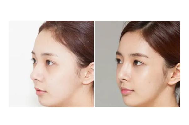 童顏針是什么成分 童顏針是干細(xì)胞嗎 童顏針是什么成分 童顏針是干細(xì)胞嗎