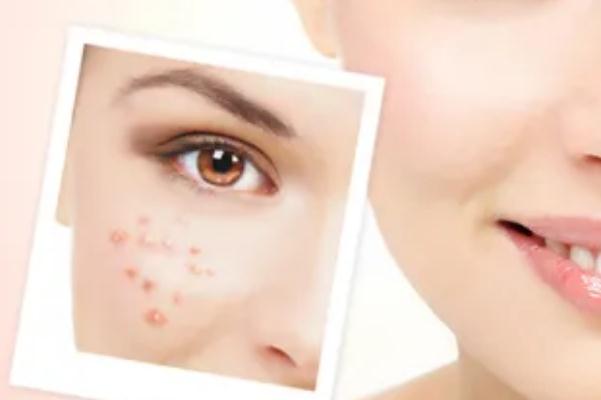 激光祛痘有副作用么 激光祛痘有后遺癥嗎 激光祛痘有副作用么 激光祛痘有后遺癥嗎