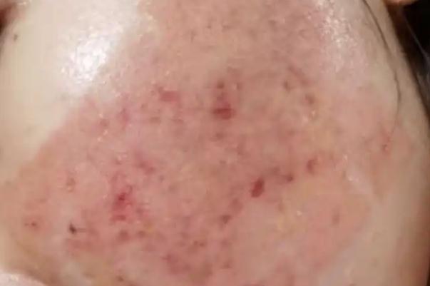 激光祛痘可以根治嗎 經(jīng)期可以做激光祛痘嗎 激光祛痘可以根治嗎 經(jīng)期可以做激光祛痘嗎