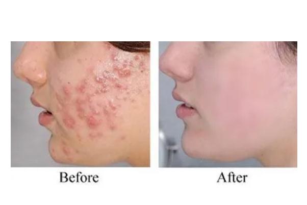 激光祛痘要滿多少歲 激光祛痘要多久恢復(fù) 激光祛痘要滿多少歲 激光祛痘要多久恢復(fù)