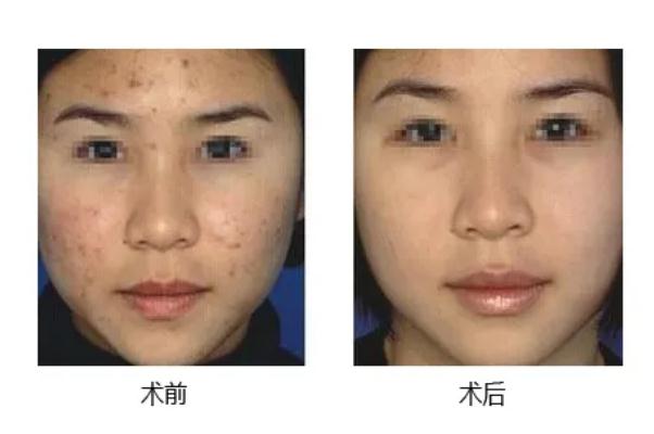 激光祛痘要滿多少歲 激光祛痘要多久恢復(fù) 激光祛痘要滿多少歲 激光祛痘要多久恢復(fù)