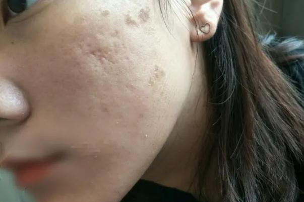 紅藍(lán)光祛痘的作用及副作用 紅藍(lán)光祛痘到底有沒有效果 紅藍(lán)光祛痘的作用及副作用 紅藍(lán)光祛痘到底有沒有效果