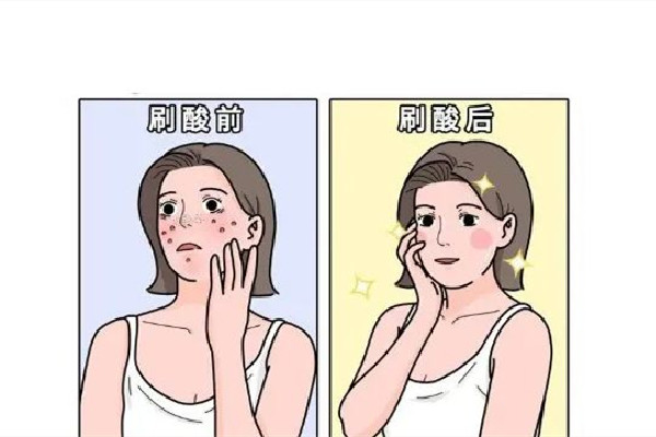 刷酸可以改善黑頭嗎 刷酸對(duì)皮膚真的有用嗎 刷酸可以改善黑頭嗎 刷酸對(duì)皮膚真的有用嗎