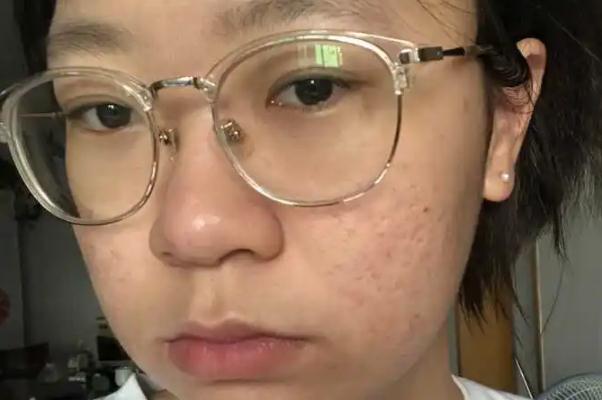 紅藍(lán)光祛痘的作用及副作用 紅藍(lán)光祛痘到底有沒有效果 紅藍(lán)光祛痘的作用及副作用 紅藍(lán)光祛痘到底有沒有效果