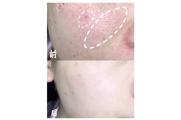 激光祛痘可以根治嗎 經(jīng)期可以做激光祛痘嗎 激光祛痘可以根治嗎 經(jīng)期可以做激光祛痘嗎