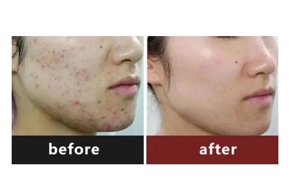 激光祛痘要滿多少歲 激光祛痘要多久恢復(fù) 激光祛痘要滿多少歲 激光祛痘要多久恢復(fù)