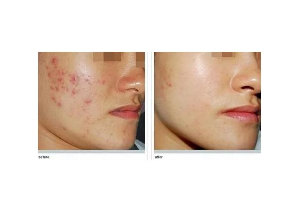 激光祛痘會(huì)留疤嗎 激光祛痘會(huì)再次復(fù)發(fā)嗎 激光祛痘會(huì)留疤嗎 激光祛痘會(huì)再次復(fù)發(fā)嗎