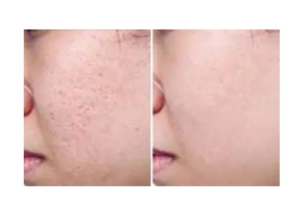 激光祛痘是永久的嗎 激光祛痘是全臉還是局部 激光祛痘是永久的嗎 激光祛痘是全臉還是局部