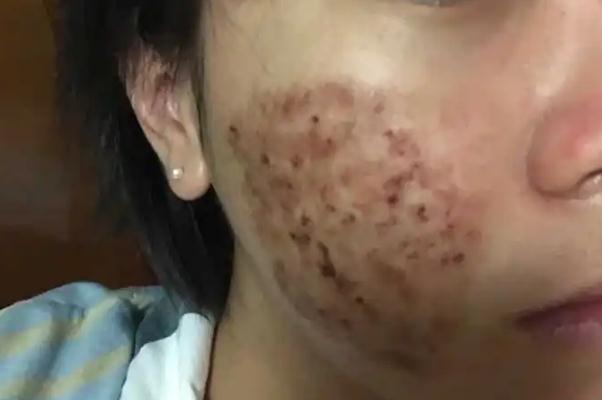 激光祛痘會留下痘坑嗎 激光祛痘會不會對皮膚有影響 激光祛痘會留下痘坑嗎 激光祛痘會不會對皮膚有影響