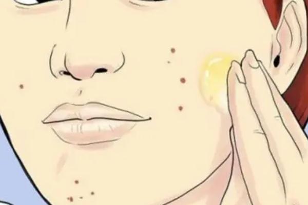 激光祛痘會留下痘坑嗎 激光祛痘會不會對皮膚有影響 激光祛痘會留下痘坑嗎 激光祛痘會不會對皮膚有影響