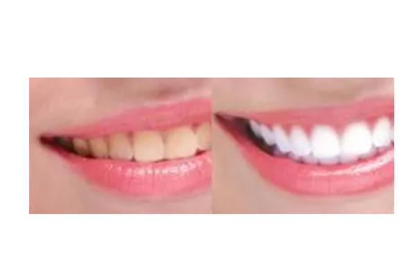 冷光美白牙齒會反彈嗎 冷光美白牙齒會酸幾天 冷光美白牙齒會反彈嗎 冷光美白牙齒會酸幾天