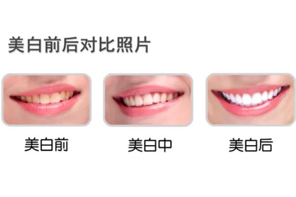 冷光美白牙齒是全口嗎 什么是牙齒冷光美白 冷光美白牙齒是全口嗎 什么是牙齒冷光美白