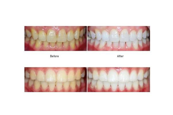 冷光美白牙齒可以白到啥程度 冷光美白牙齒可以做幾次 冷光美白牙齒可以白到啥程度 冷光美白牙齒可以做幾次