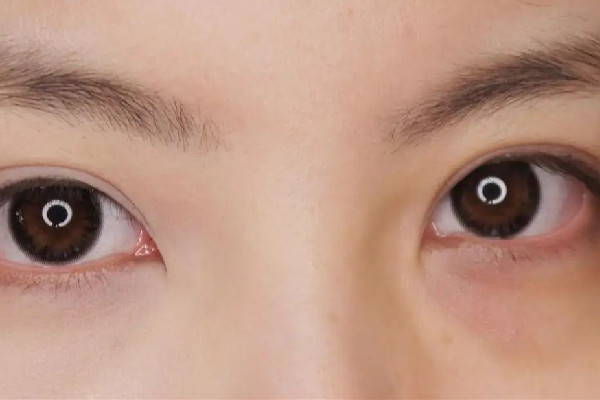 淚溝填充可以維持多久 淚溝填充多久才能恢復(fù)自然 淚溝填充可以維持多久 淚溝填充多久才能恢復(fù)自然