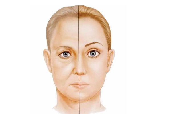 填淚溝填成眼袋怎么辦 填淚溝會不會造成失明 填淚溝填成眼袋怎么辦 填淚溝會不會造成失明