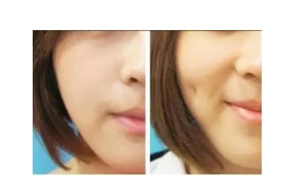 人造酒窩會消失嗎 酒窩成形術適合臉頰消瘦的人嗎 人造酒窩會消失嗎 酒窩成形術適合臉頰消瘦的人嗎