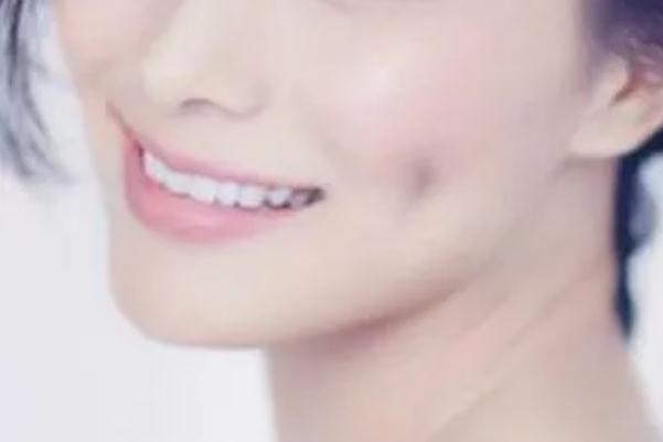 人造酒窩會消失嗎 酒窩成形術適合臉頰消瘦的人嗎 人造酒窩會消失嗎 酒窩成形術適合臉頰消瘦的人嗎