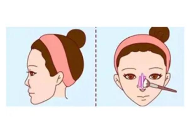 朝天鼻矯正有后遺癥么 朝天鼻該如何矯正過來 朝天鼻矯正有后遺癥么 朝天鼻該如何矯正過來