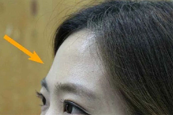 豐額頭用什么方法最好 額頭填充可以永久嗎 豐額頭用什么方法最好 額頭填充可以永久嗎