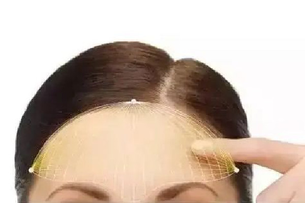 額頭填充一般要多少錢 額頭填充去什么醫(yī)院 額頭填充一般要多少錢 額頭填充去什么醫(yī)院